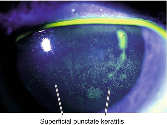 Superficial Punctate Keratitis